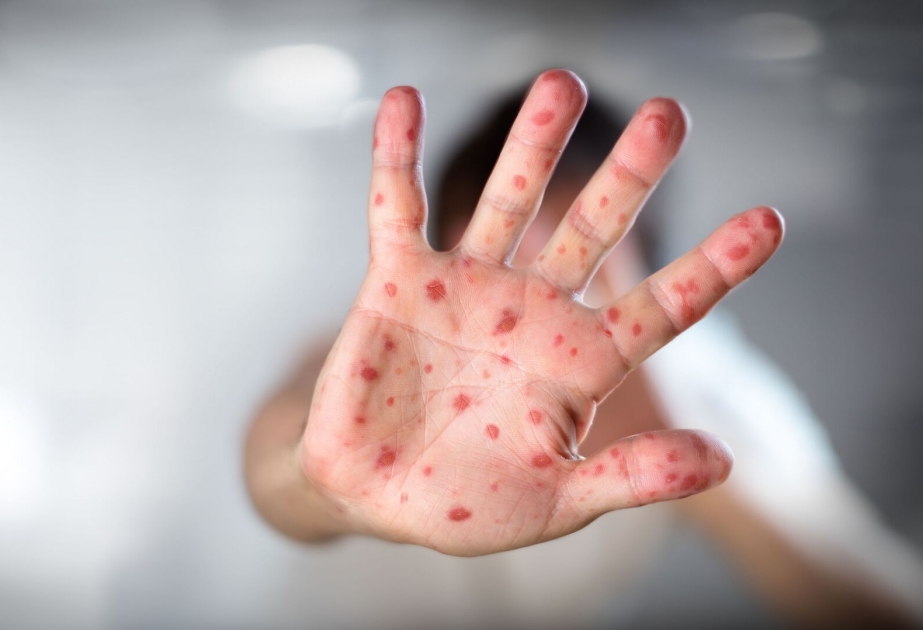 Olkede qizilca ve suciceyi ile bagli epidemioloji veziyyet stabildir - Nazirlik