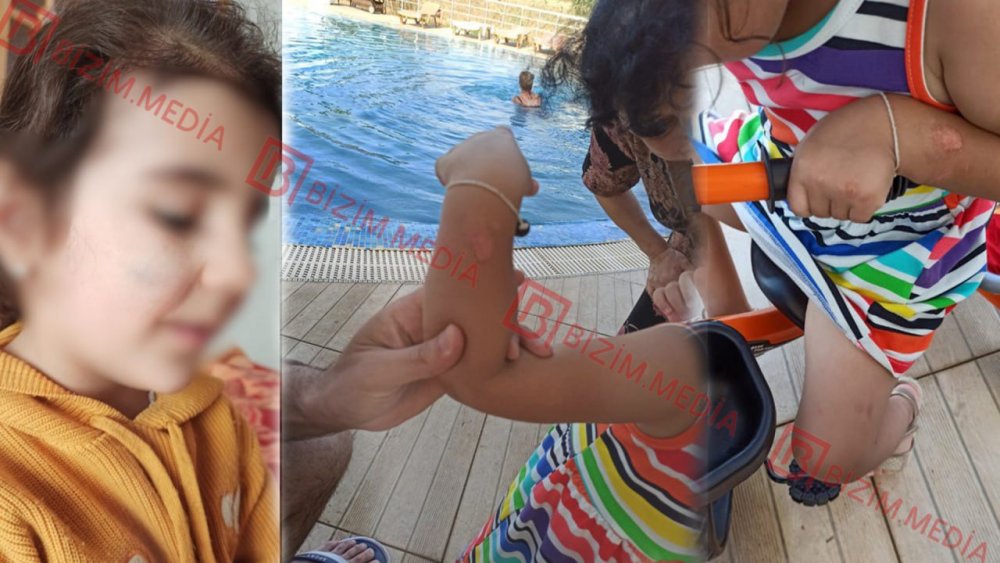 Lenkeranda qandonduran HADISE – Ana isti qasiqla 3 yasli qizinin qolunu DAGLADI – FOTO/VIDEO