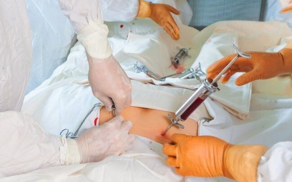 Sumuk iliyinin transplantasiyasini heyata kecirecek xestexanalarin sayi artirilib